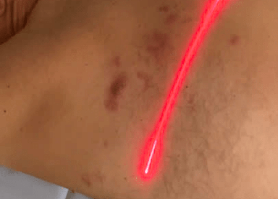 Herpes zóster: tratamiento del dolor con láser scanner