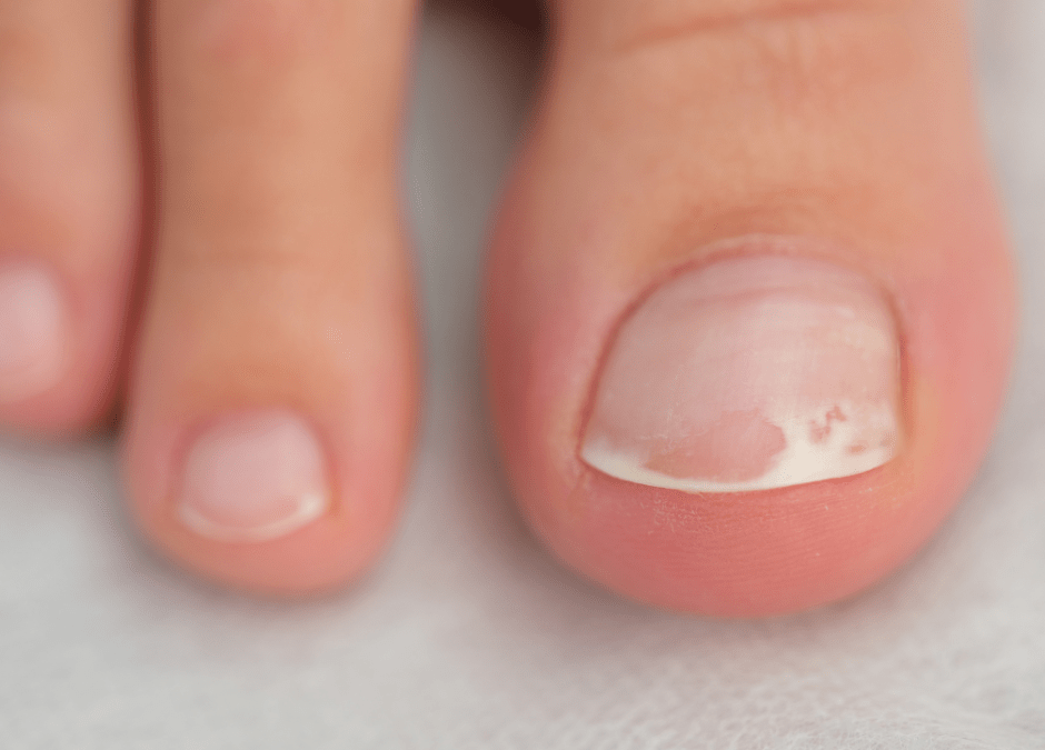 Tratamiento láser para hongos en las uñas: una solución rápida y efectiva