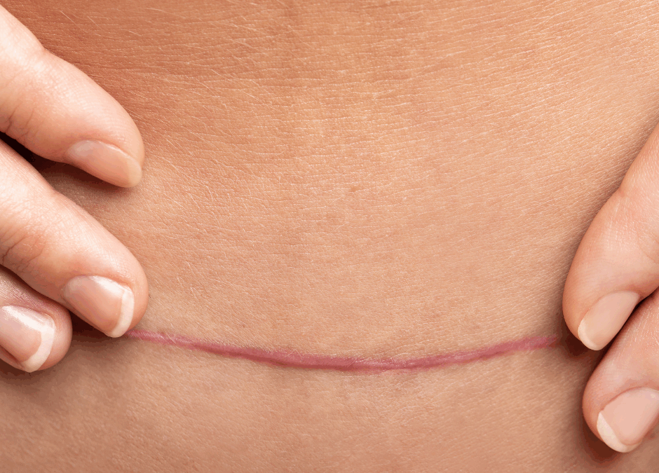 ¿Qué es la fibrosis post-intervención quirúrgica?