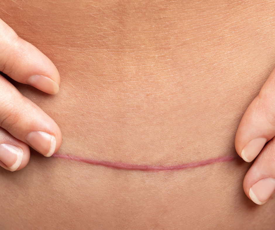 cricatriu de postintervenció quirúrgica