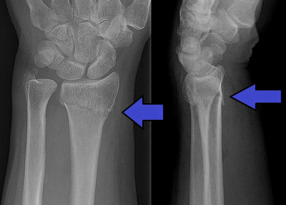Què és una fractura de Colles i per què es produeix?